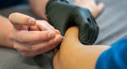 dry needling